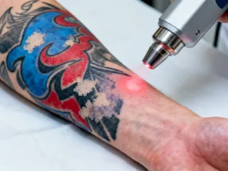 Tattoo removal with Cutera enlighten laser