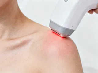 Laser hair removal with Cutera CoolGlide