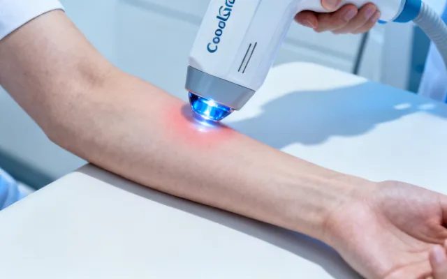 Cutera CoolGlide laser hair removal treatment